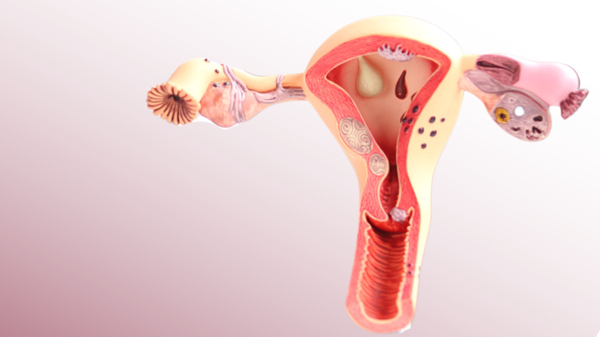 histeroscopia histeroscopia