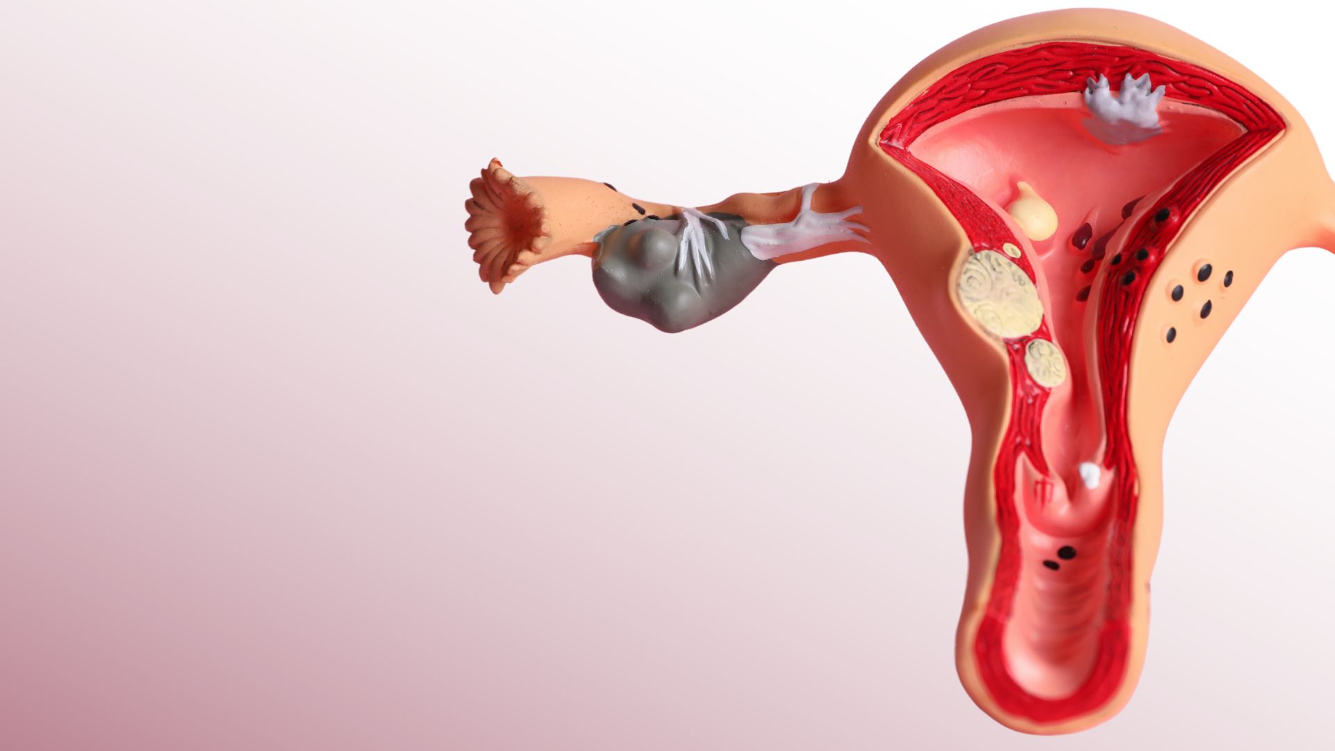 mioma uterino mioma uterino